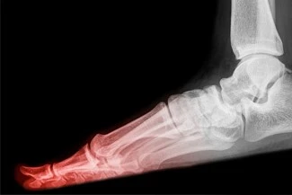 AFO Ankle Foot Orthosis Indications03 AFO Ankle Foot Orthosis Indications03